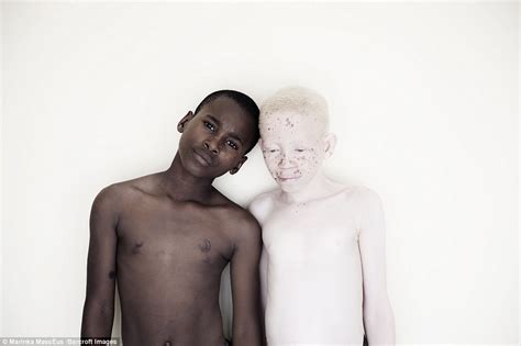 Albinos In Tanzania Who Face Being Killed For Body Parts Daily Mail Online