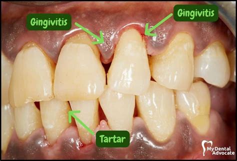 What Does Gingivitisgum Disease Look Like 20 Pictures