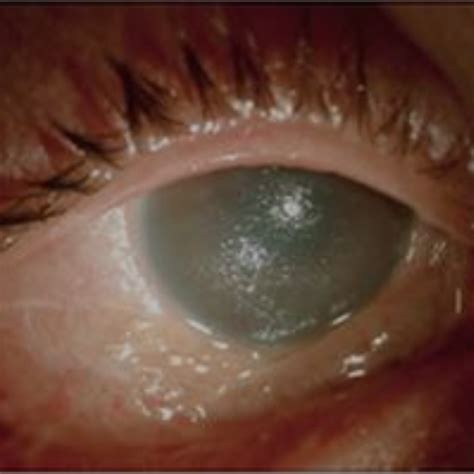 Chemical Eye Burns Rcemlearning India