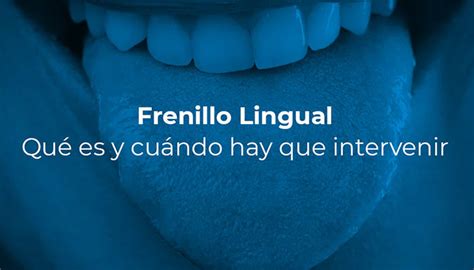 Frenillo Lingual Qu Es Y Cu Ndo Hay Que Intervenir Ccm Dental