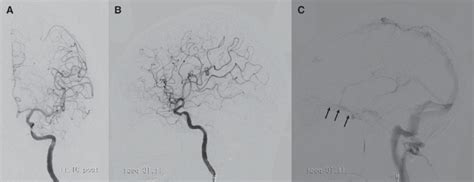 Postoperative DSA Of The Left ICA A AP View B Lateral View Of The