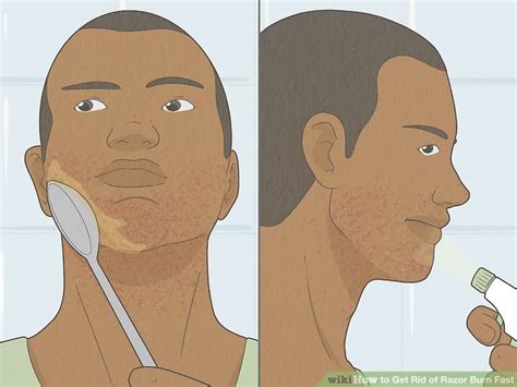 To Prevent Razor Burn On Neck