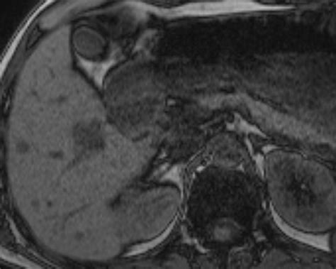 Liver Atlas Diagnosis Angiosarcoma