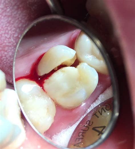 Cracked Tooth Of The Day Dr Gentry