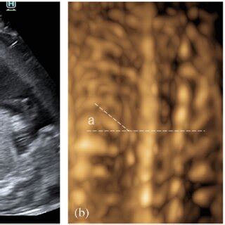 Fetal Ultrasound Images Of The KOS14 Case A B And A Normal Case C