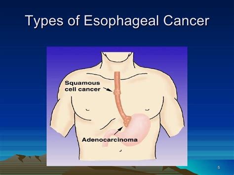 11 Esophageal Cancer