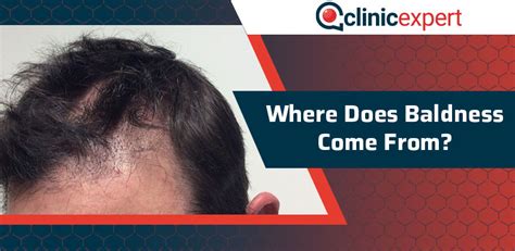 Where Does Baldness Come From Clinicexpert