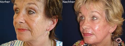 Facelift Mit Dem Laser In M Nchen Gesichtsstraffung Ohne Op