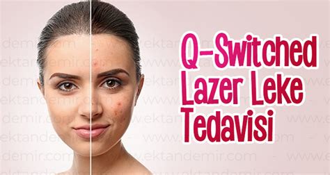 Q Switched Lazer Leke Tedavisi Dermatolog Dr Ektan Demir