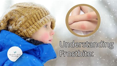 Understanding Frostbite Signs Symptoms And Risk Factors Youtube