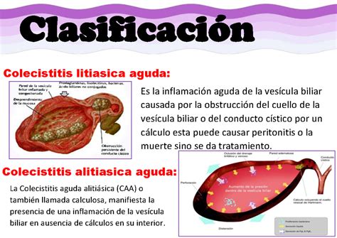 Doc2122 Rumen Clasificación Colecistitis litiasica aguda Es la