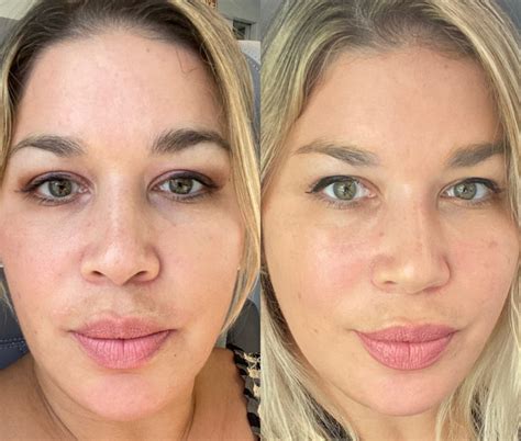 Lasers Botox Or Filler What Has Worked Best For My Skin At 45