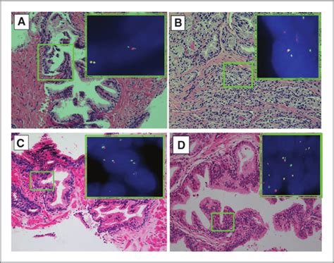 H E Stains And Corresponding Fish Images Of Erg Rearrangement In