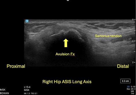 Asis Avulsion Fracture