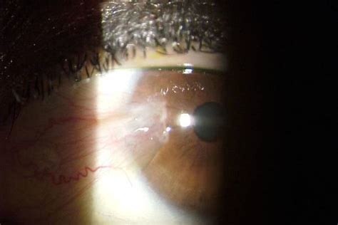 Pterygium - Ophthalmologist Union City | NeoVision Eye Center