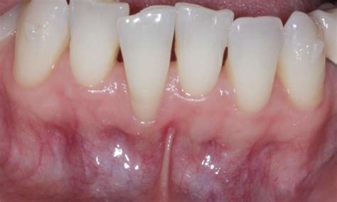 Gum Grafting Before And After Photos Temple City Ca