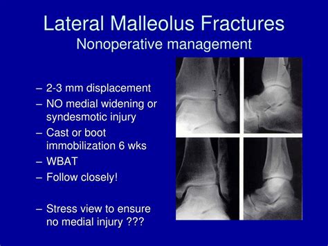 Ppt Ankle Fractures Powerpoint Presentation Free Download Id6654288