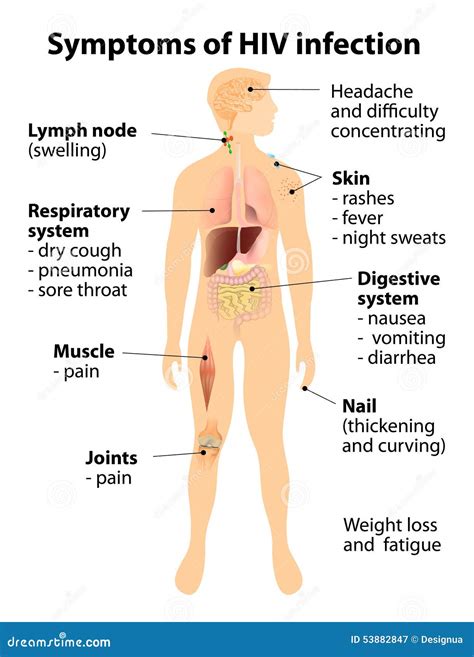 Sintomi Di Infezione HIV Illustrazione Vettoriale Illustrazione Di