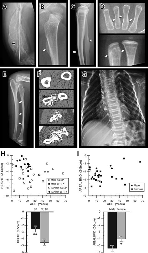 Osteogenesis Imperfecta Type V Marked Phenotypic Variability Despite