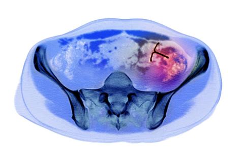 Ectopic Iud Contraceptive Ct Scan Photograph By Du Cane Medical