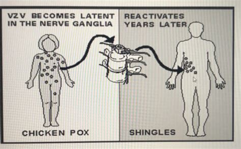 HERPES ZOSTER PAIN Treatment Flashcards Quizlet