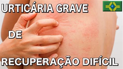 URTICÁRIA GRAVE DE RECUPERAÇÃO DIFÍCIL Quais os tipos e Como definir