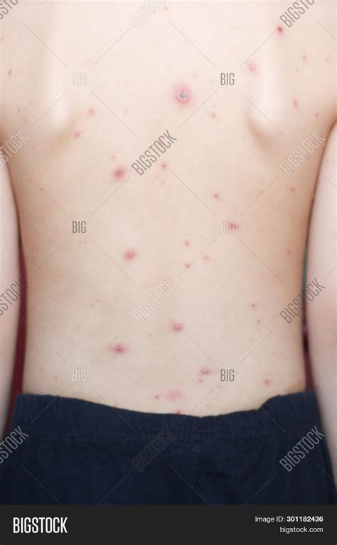 Chicken Pox Rash On Image & Photo (Free Trial) | Bigstock