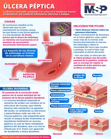 Úlceras pépticas