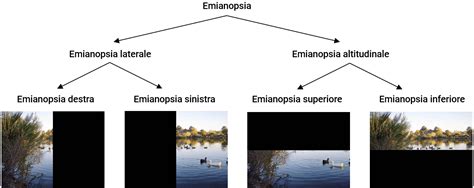 Types Of Hemianopias Emianopsia