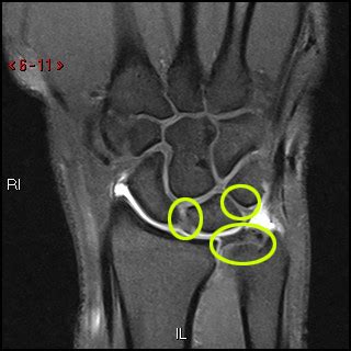 Mri Arthrogram Wrist R O Tfcc Sl Or Lt Ligament Tear Cedars Sinai