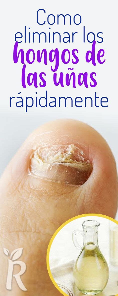 Elimina Los Hongos De Los Pies Para Siempre Con Este Simple Remedio Casero Cura Hongos En Las