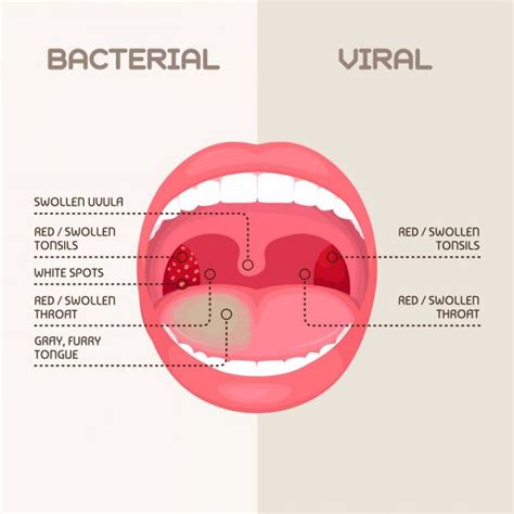 Chronic Pharyngitis Symptoms Causes Home Remedies Stdgov Blog