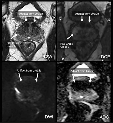 JU INSIGHT Impact Of Prostate Urethral Lift Device On Prostate Magnetic