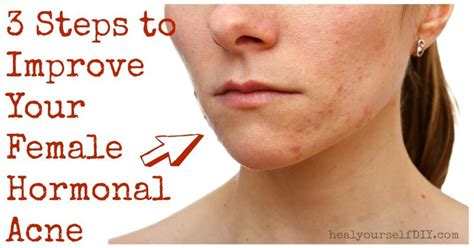 3 Steps To Improve Hormonal Acne Heal Yourself Diy Hormonal Acne