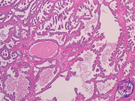 16 Male Genital Organs 1 Benign Prostatic Hypertrophy Pathology Core