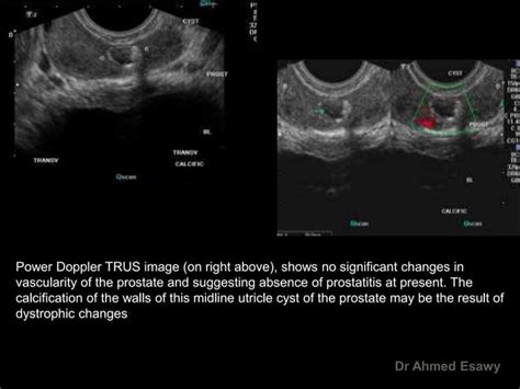 Imaging Prostatitis Urethritis Dr Ahmed Esawy Ppt