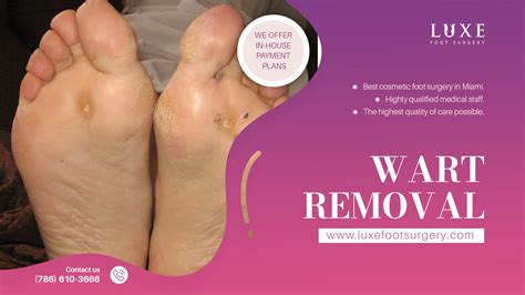 Affordable Plantar Wart Removal in Miami Starting at $500