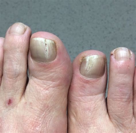 Fungal Nails - O'Dwyer Podiatry