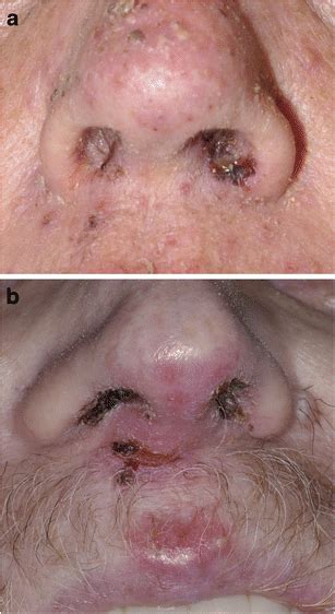 Nasal Vestibulitis Pictures - Nose Endoscopy : Vestibulitis due to ...