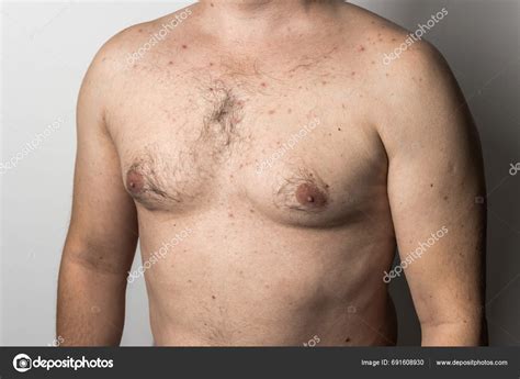 Naked Man Red Pimples His Chest Acne Skin Disease Dermatology Stock