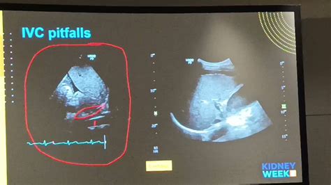 NephroPOCUS On Twitter RT Dvdrry The First Step Is ICV Evaluation