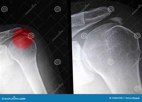 Painfull Shoulder Calcific Tendonitis Tendinitis Stock Photo Image