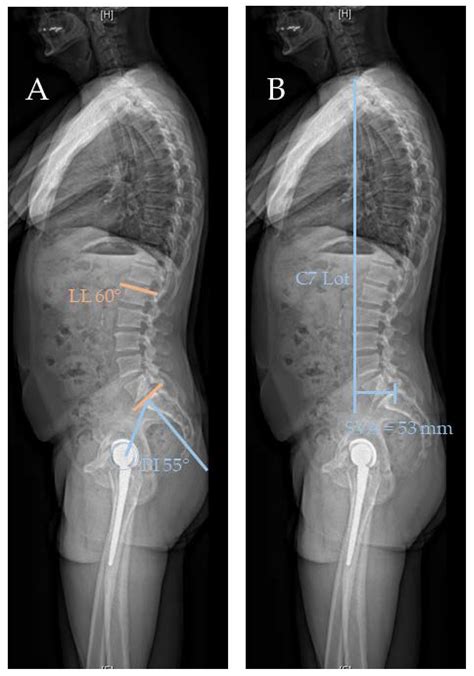 Jcm Free Full Text The Impact Of Spinopelvic Mobility On