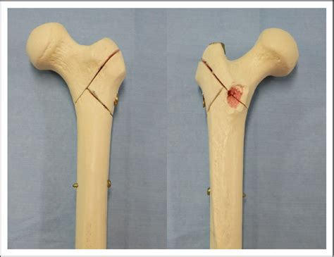 Figure From Biomechanical Comparison Of Short Mid And Long Length