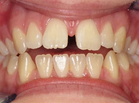 Invisalign Treating Open Bite Space Diastema Between Front Teeth Before