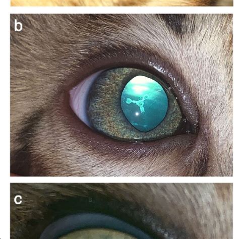 A Nuclear Cataract White Arrow With Posterior Suture Line Cataract