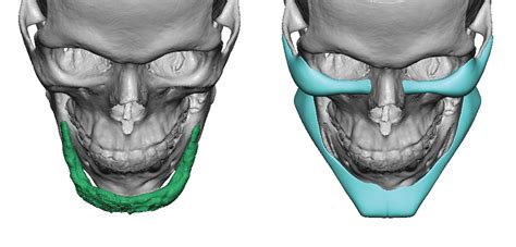 Custom Jaw Implants Chin Implants Eppley Custom Facial Implants