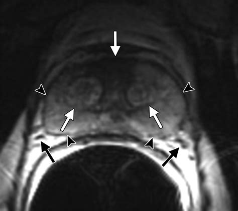 Advancements In Mr Imaging Of The Prostate From Diagnosis To