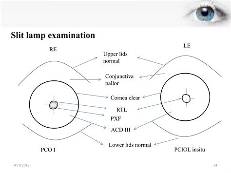 Posterior Capsular Opacification Ppt