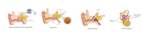 Common Vestibular Disorders Opto Mization Neurovisual Performance